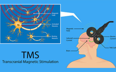 How Long Does TMS Take to Work?