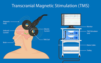 Accelerated TMS Therapy: A Comprehensive Guide