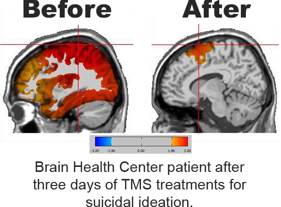 Progress comparison of a patient at a brain health center before and after three days of TMS treatments for suicide ideation.