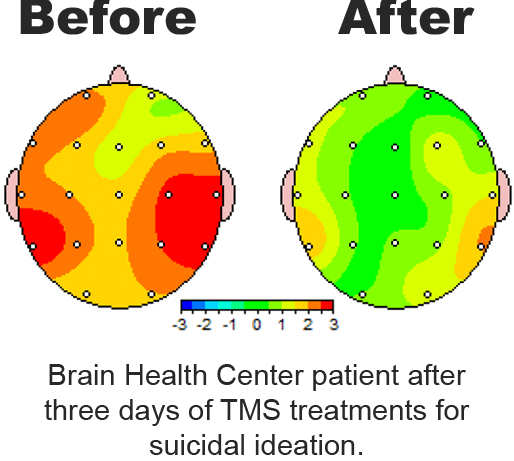 Before and after images of a patient at a brain health center, showing progress after three days of TMS treatments.