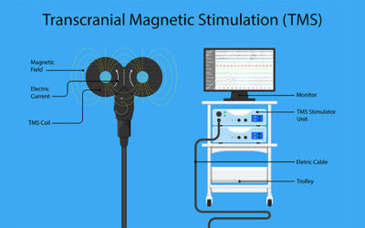 Does TMS Work For Anxiety? What You Need to Know