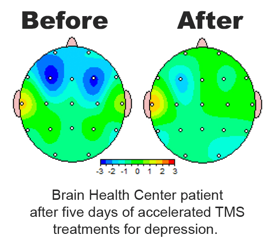 Before-and-after photos of a patient at a brain health center after undergoing five days of accelerated TMS treatments