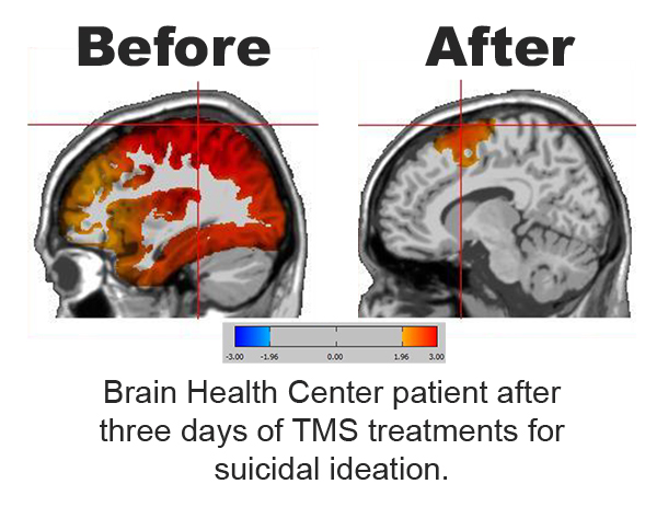 Image showing a patient before and after three days of TMS treatments for suicide at a brain health center.