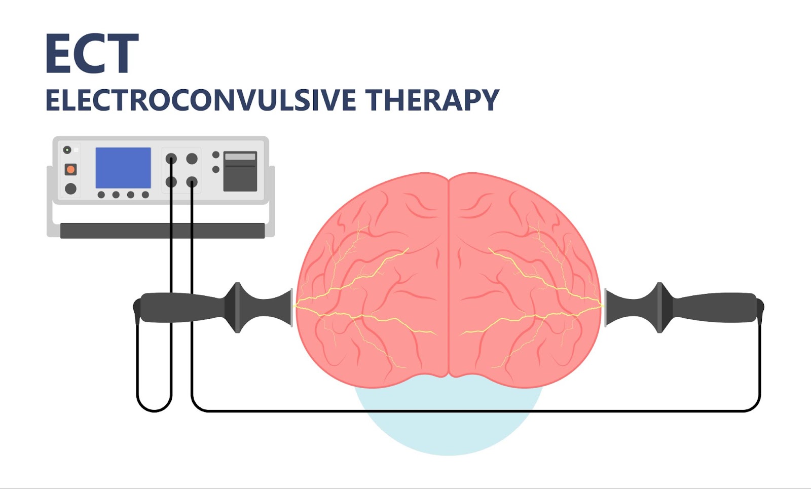 A visual representation of electroconvulsive therapy, a treatment method for various mental health conditions